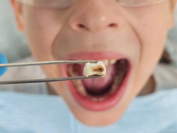 Best Emergency Treatment for Toothache in Milan, OH